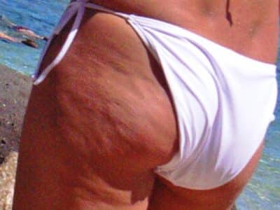 Dimpled_appearance_of_cellulite