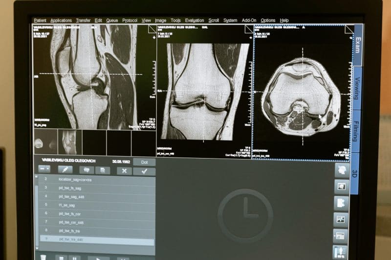 Artróza kolene přírodní léčba